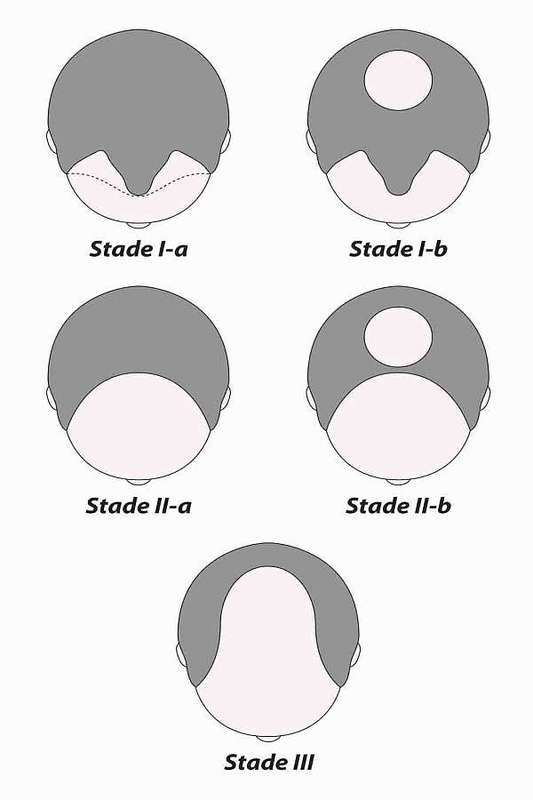Kreslené hlavy znázorňující různé způsoby vypadávání vlasů